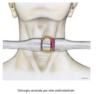 Myelopathie Cervicarthrosique - Fiches patients - Espace patients ...